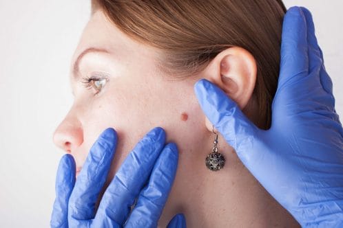 Doctor checking mole on woman's face