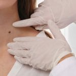 check moles for signs of cancer