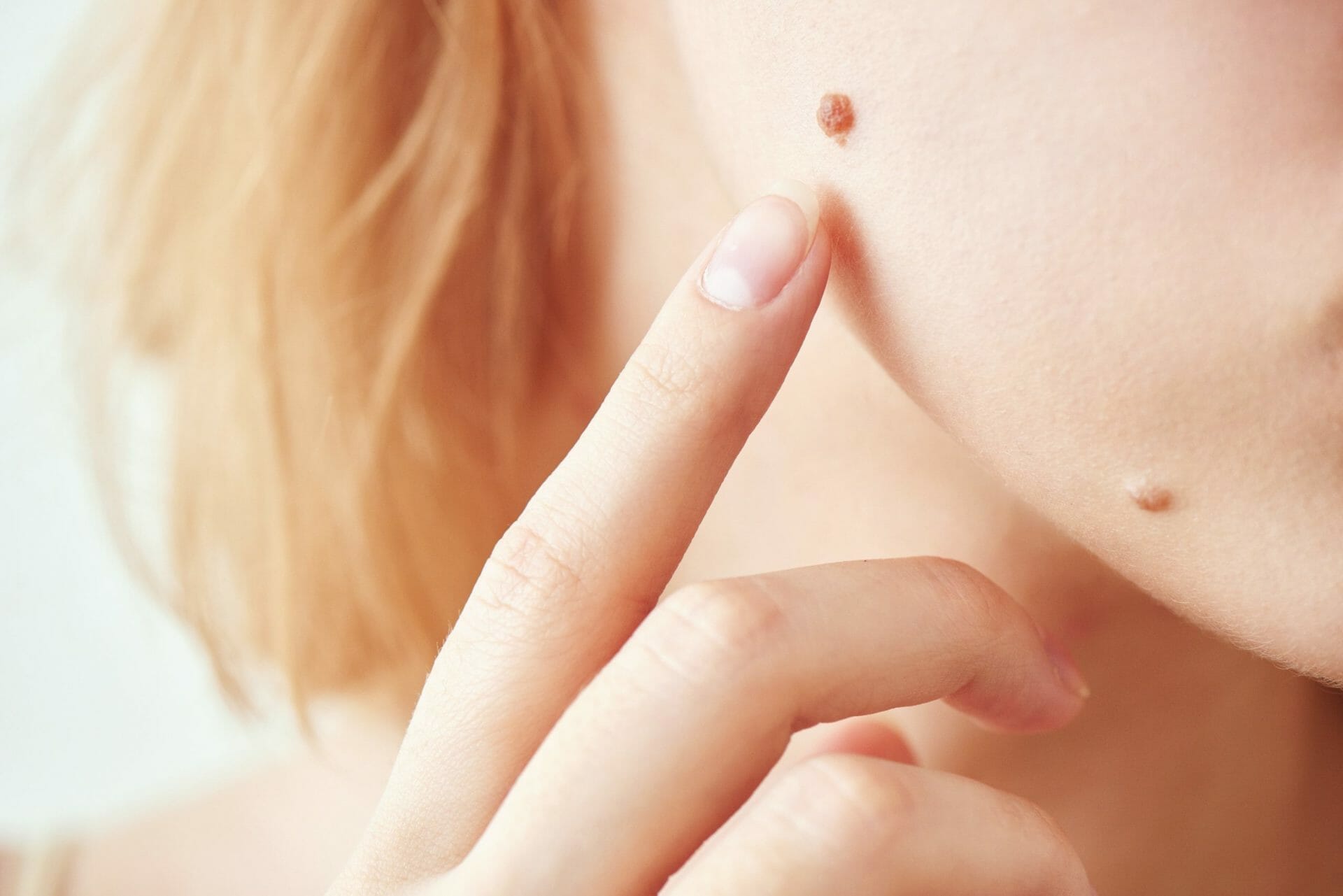 Mole Removal: What You Can Expect Before, During, and After   SELF