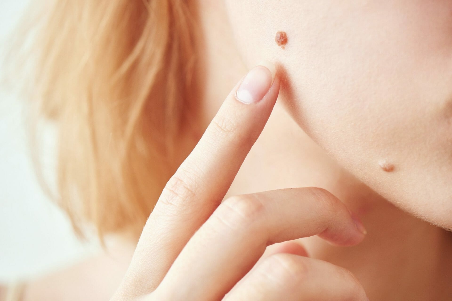 Mole Removal For Money